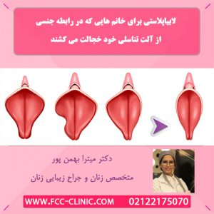 عکس های لابیاپلاستی بعد از عمل