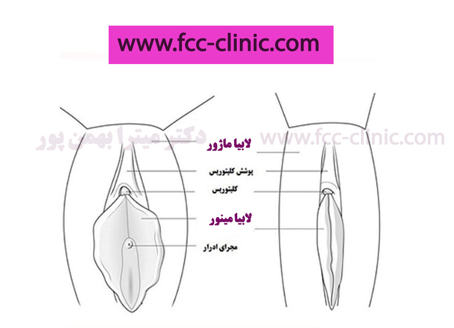 لابیا مینور قبل و بعد از لابیاپلاستی