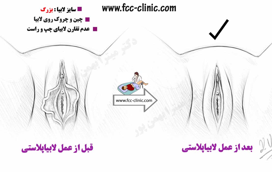 عکس تجربه عمل لابیاپلاستی