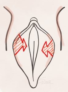 لابیاپلاستی به روش z plasty