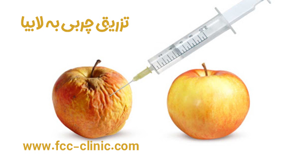 عکس-تزریق-چربی-به-واژن