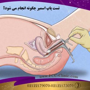 تست پاپ اسمیر چگونه انجام می شود؟
