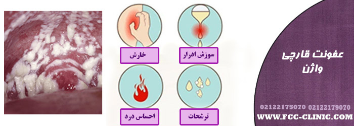 عفونت قارچی همراه با ترشحات و سوزش ادرار
