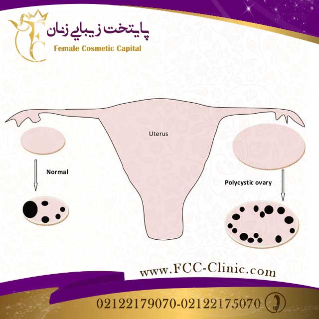 بارداری با تنبلی تخمدان شدید
