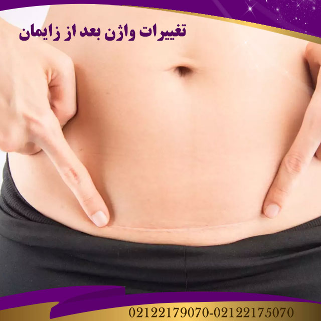 تغییرات وازن بعد از زایمان سزارین