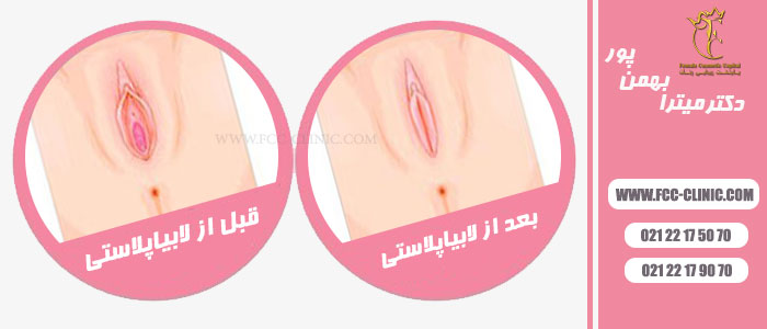 عکس شماتیک قبل و بعد از لابیاپلاستی