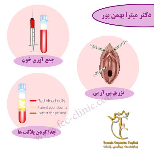 تزریق پی آر پی به واژن